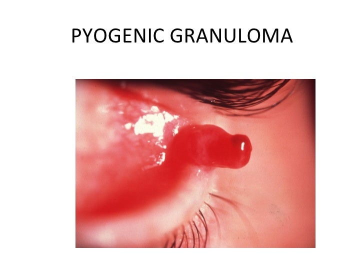 Eyelid inflammation & tumors