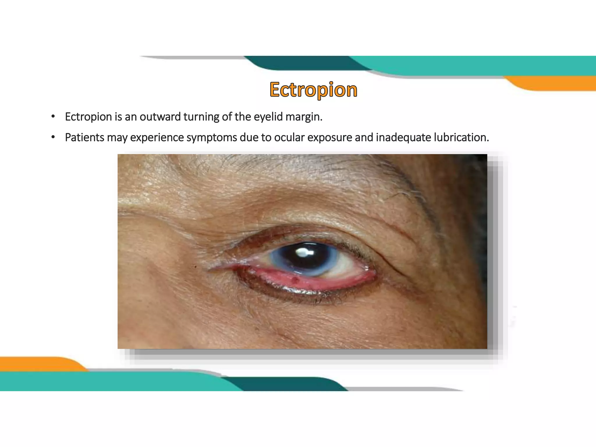 Eyelid malposition | PPTX