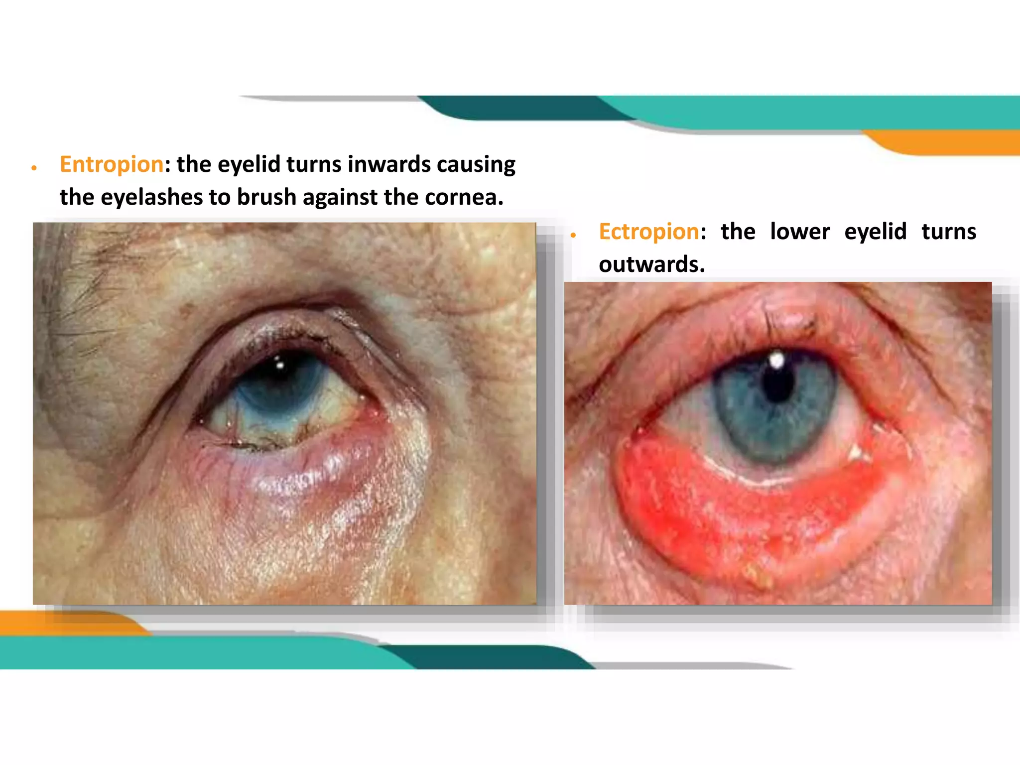 Eyelid malposition | PPTX