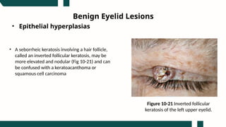 Inverted Seb K Eyelid Neoplasms aao reading pediatrik oftalmologi | PPTX