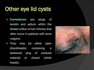 Eyelid pathology 1 | PDF