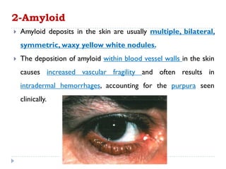  Amyloid deposits in the skin are usually multiple, bilateral,
symmetric, waxy yellow white nodules.
 The deposition of amyloid within blood vessel walls in the skin
causes increased vascular fragility and often results in
intradermal hemorrhages, accounting for the purpura seen
clinically.
2-Amyloid
 