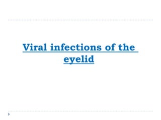 Viral infections of the
eyelid
 