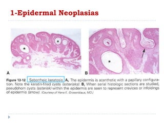 1-Epidermal Neoplasias
 