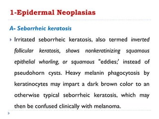 A- Seborrheic keratosis
 Irritated seborrheic keratosis, also termed inverted
follicular keratosis, shows nonkeratinizing squamous
epithelial whorling, or squamous "eddies;' instead of
pseudohorn cysts. Heavy melanin phagocytosis by
keratinocytes may impart a dark brown color to an
otherwise typical seborrheic keratosis, which may
then be confused clinically with melanoma.
1-Epidermal Neoplasias
 