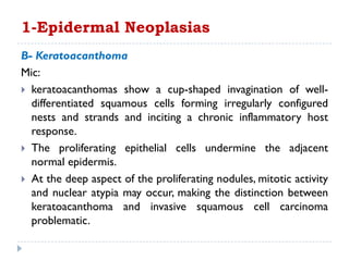 B- Keratoacanthoma
Mic:
 keratoacanthomas show a cup-shaped invagination of well-
differentiated squamous cells forming irregularly configured
nests and strands and inciting a chronic inflammatory host
response.
 The proliferating epithelial cells undermine the adjacent
normal epidermis.
 At the deep aspect of the proliferating nodules, mitotic activity
and nuclear atypia may occur, making the distinction between
keratoacanthoma and invasive squamous cell carcinoma
problematic.
1-Epidermal Neoplasias
 