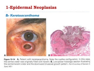 B- Keratoacanthoma
1-Epidermal Neoplasias
 