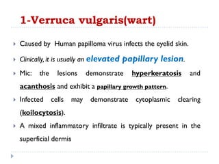 1-Verruca vulgaris(wart)
 Caused by Human papilloma virus infects the eyelid skin.
 Clinically, it is usually an elevated papillary lesion.
 Mic: the lesions demonstrate hyperkeratosis and
acanthosis and exhibit a papillary growth pattern.
 Infected cells may demonstrate cytoplasmic clearing
(koilocytosis).
 A mixed inflammatory infiltrate is typically present in the
superficial dermis
 
