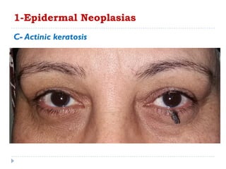 C- Actinic keratosis
1-Epidermal Neoplasias
 