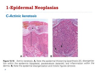 C-Actinic keratosis
1-Epidermal Neoplasias
 