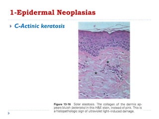  C-Actinic keratosis
1-Epidermal Neoplasias
 