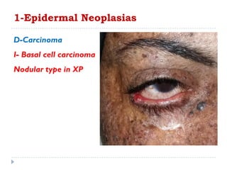 D-Carcinoma
I- Basal cell carcinoma
Nodular type in XP
1-Epidermal Neoplasias
 