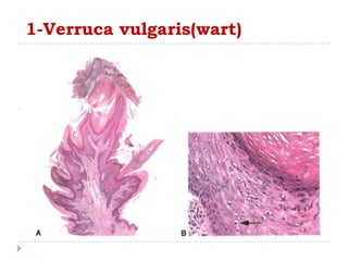 1-Verruca vulgaris(wart)
 