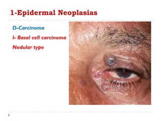 1-Epidermal Neoplasias
D-Carcinoma
I- Basal cell carcinoma
Nodular type
 