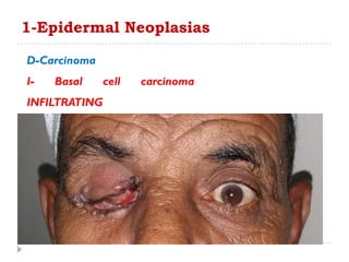 1-Epidermal Neoplasias
D-Carcinoma
I- Basal cell carcinoma
INFILTRATING
 