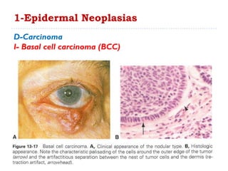 1-Epidermal Neoplasias
D-Carcinoma
I- Basal cell carcinoma (BCC)
 