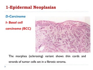 D-Carcinoma
I- Basal cell
carcinoma (BCC)
1-Epidermal Neoplasias
The morphea (sclerosing) variant shows thin cords and
strands of tumor cells set in a fibrotic stroma.
 