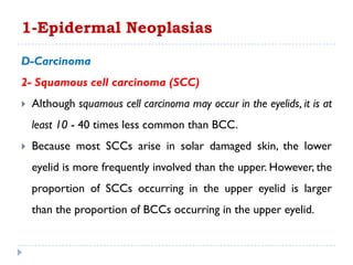 D-Carcinoma
2- Squamous cell carcinoma (SCC)
 Although squamous cell carcinoma may occur in the eyelids, it is at
least 10 - 40 times less common than BCC.
 Because most SCCs arise in solar damaged skin, the lower
eyelid is more frequently involved than the upper. However, the
proportion of SCCs occurring in the upper eyelid is larger
than the proportion of BCCs occurring in the upper eyelid.
1-Epidermal Neoplasias
 