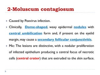  Caused by Poxvirus infection.
 Clinically, Dome-shaped, waxy epidermal nodules with
central umbilication form and, if present on the eyelid
margin, may cause a secondary follicular conjunctivitis.
 Mic: The lesions are distinctive, with a nodular proliferation
of infected epithelium producing a central focus of necrotic
cells (central crater) that are extruded to the skin surface.
2-Moluscum contagiosum
 