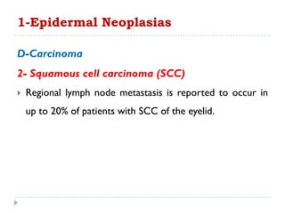 D-Carcinoma
2- Squamous cell carcinoma (SCC)
 Regional lymph node metastasis is reported to occur in
up to 20% of patients with SCC of the eyelid.
1-Epidermal Neoplasias
 