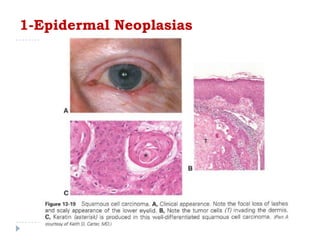 1-Epidermal Neoplasias
 