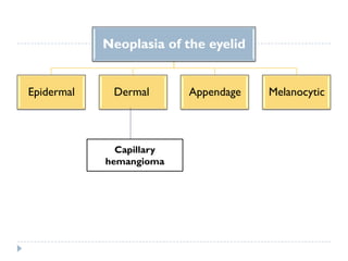 Neoplasia of the eyelid
Epidermal Dermal Appendage Melanocytic
Capillary
hemangioma
 