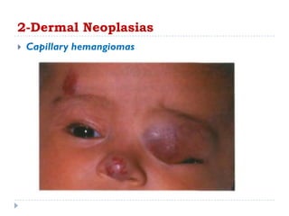  Capillary hemangiomas
2-Dermal Neoplasias
 