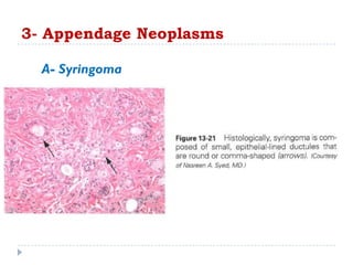 A- Syringoma
3- Appendage Neoplasms
 