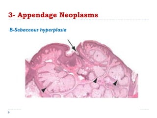3- Appendage Neoplasms
B-Sebaceous hyperplasia
 