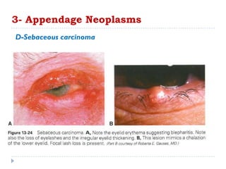 3- Appendage Neoplasms
D-Sebaceous carcinoma
 