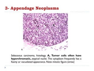 Sebaceous carcinoma, histology. A, Tumor cells often have
hyperchromatic, atypical nuclei. The cytoplasm frequently has a
foamy or vacuolated appearance. Note mitotic figure (arrow)
3- Appendage Neoplasms
 