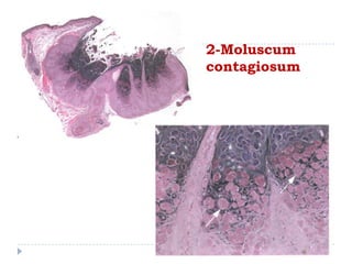 2-Moluscum
contagiosum
 