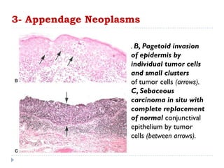 . B, Pagetoid invasion
of epidermis by
individual tumor cells
and small clusters
of tumor cells (arrows).
C, Sebaceous
carcinoma in situ with
complete replacement
of normal conjunctival
epithelium by tumor
cells (between arrows).
3- Appendage Neoplasms
 