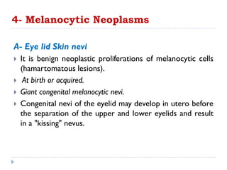 A- Eye lid Skin nevi
 It is benign neoplastic proliferations of melanocytic cells
(hamartomatous lesions).
 At birth or acquired.
 Giant congenital melanocytic nevi.
 Congenital nevi of the eyelid may develop in utero before
the separation of the upper and lower eyelids and result
in a "kissing" nevus.
4- Melanocytic Neoplasms
 