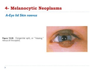 A-Eye lid Skin naevus
4- Melanocytic Neoplasms
 