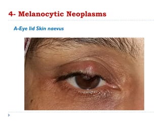 4- Melanocytic Neoplasms
A-Eye lid Skin naevus
 