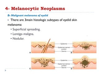 B- Malignant melanoma of eyelid
 There are 3main histologic subtypes of eyelid skin
melanoma:
• Superficial spreading.
• Lentigo maligna.
• Nodular.
4- Melanocytic Neoplasms
 