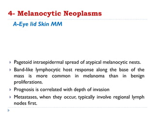  Pagetoid intraepidermal spread of atypical melanocytic nests.
 Band-like lymphocytic host response along the base of the
mass is more common in melanoma than in benign
proliferations.
 Prognosis is correlated with depth of invasion
 Metastases, when they occur, typically involve regional lymph
nodes first.
4- Melanocytic Neoplasms
A-Eye lid Skin MM
 