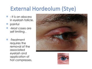 - It is an abscess
  in eyelash follicle.
 painful
 -Most cases are
  self limiting .

   -Treatment
    requires the
    removal of the
    associated
    eyelash and
    application of
    hot compresses.
 