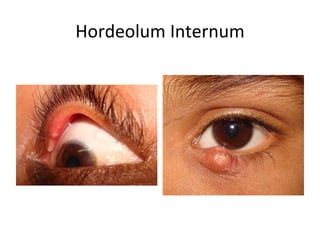 Hordeolum Internum
 