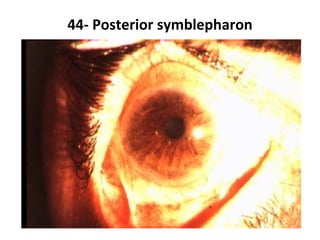 44- Posterior symblepharon
 