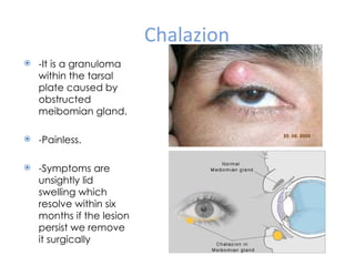 Chalazion
   -It is a granuloma
    within the tarsal
    plate caused by
    obstructed
    meibomian gland.

   -Painless.

   -Symptoms are
    unsightly lid
    swelling which
    resolve within six
    months if the lesion
    persist we remove
    it surgically
 