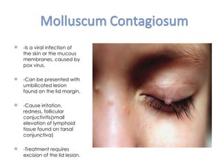   -Is a viral infection of
    the skin or the mucous
    membranes, caused by
    pox virus.

   -Can be presented with
    umbilicated lesion
    found on the lid margin.

   -Cause irritation,
    redness, follicular
    conjuctivitis(small
    elevation of lymphoid
    tissue found on tarsal
    conjunctiva)

   -Treatment requires
    excision of the lid lesion.
 
