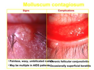 Molluscum contagiosum
            Signs                        Complications




• Painless, waxy, umbilicated nodule
                                • Chronic follicular conjunctivitis
• May be multiple in AIDS patientsOccasionally superficial keratitis
                                •
 