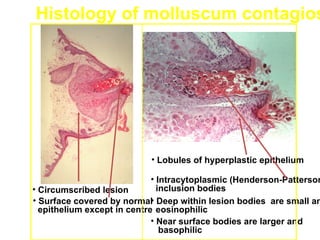 Histology of molluscum contagios




                           • Lobules of hyperplastic epithelium

                             • Intracytoplasmic (Henderson-Patterson
• Circumscribed lesion         inclusion bodies
• Surface covered by normal Deep within lesion bodies are small an
                             •
  epithelium except in centre eosinophilic
                             • Near surface bodies are larger and
                                basophilic
 