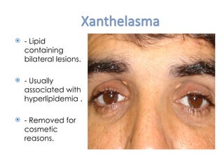    - Lipid
    containing
    bilateral lesions.

   - Usually
    associated with
    hyperlipidemia .

   - Removed for
    cosmetic
    reasons.
 