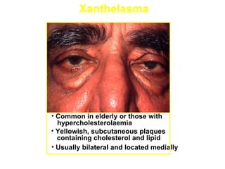 Xanthelasma




• Common in elderly or those with
  hypercholesterolaemia
• Yellowish, subcutaneous plaques
  containing cholesterol and lipid
• Usually bilateral and located medially
 