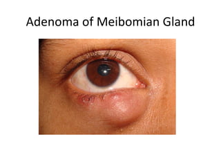 Adenoma of Meibomian Gland
 