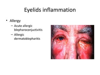 Eyelids inflammation
• Allergy
   – Acute allergic
     blepharoconjuctivitis
   – Allergic
     dermatoblepharitis
 