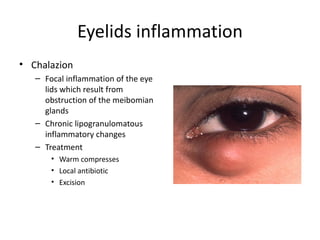 Eyelids inflammation
• Chalazion
   – Focal inflammation of the eye
     lids which result from
     obstruction of the meibomian
     glands
   – Chronic lipogranulomatous
     inflammatory changes
   – Treatment
       • Warm compresses
       • Local antibiotic
       • Excision
 